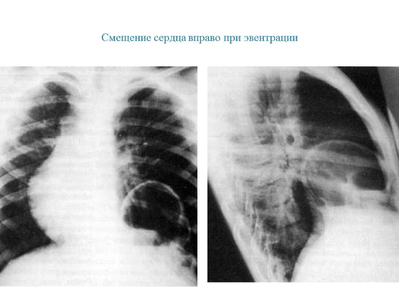 Смещение сердца вправо при эвентрации